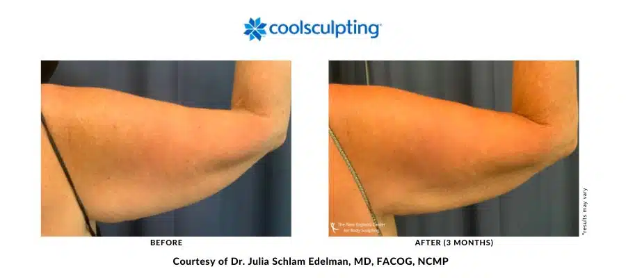 Actual before and after image of a CoolSculpting Elite treatment on the arm area by Dr. Julia Edelman in Middleboro, MA