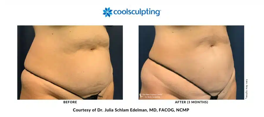 CoolSculpting Elite abdomen before and after treatment with Dr. Julia Edelman in Middleboro, MA