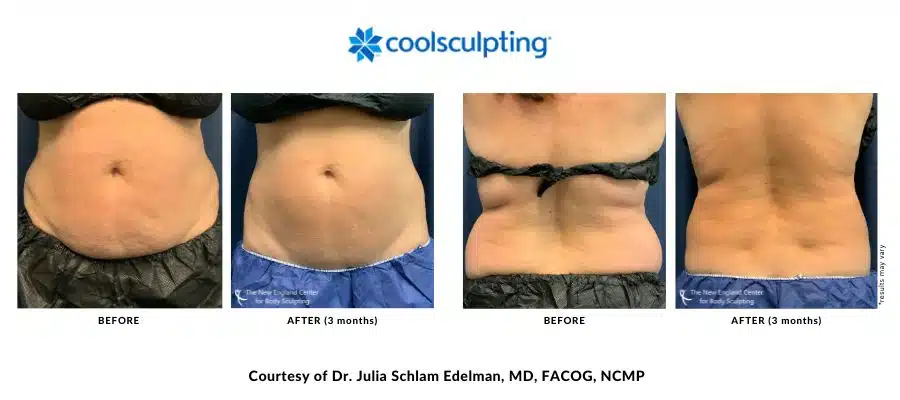 Actual CoolSculpting Elite before and after treatment images by Dr. Julia Edelman