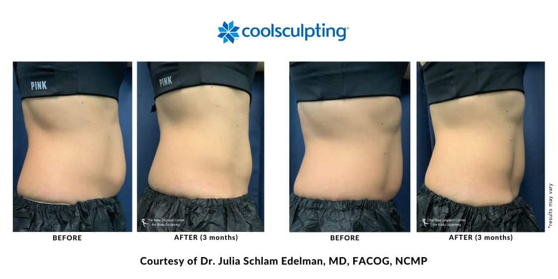 coolsculpting-elite-before-and-after-dr.-edelman-mobile-1 CoolSculpting Elite abdomen area before and after treatment by Dr. Edelman