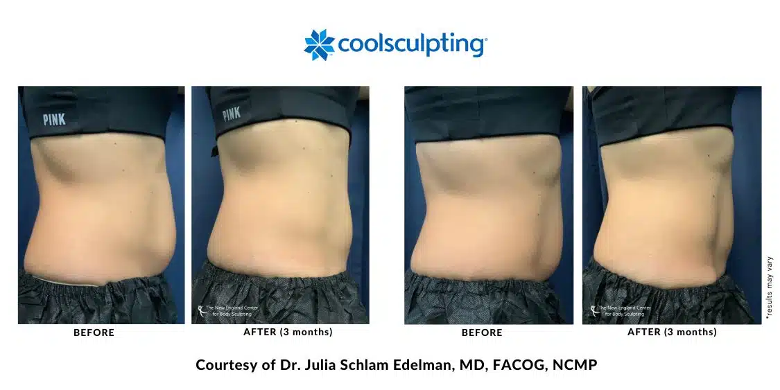 CoolSculpting Elite abdomen area before and after treatment by Dr. Edelman