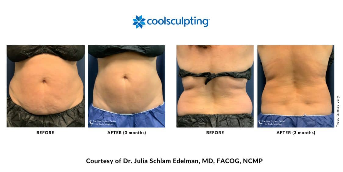 coolsculpting-elite-before-and-after-dr.-edelman-mobile-10 Actual CoolSculpting Elite before and after treatment images by Dr. Julia Edelman in Middleboro, MA