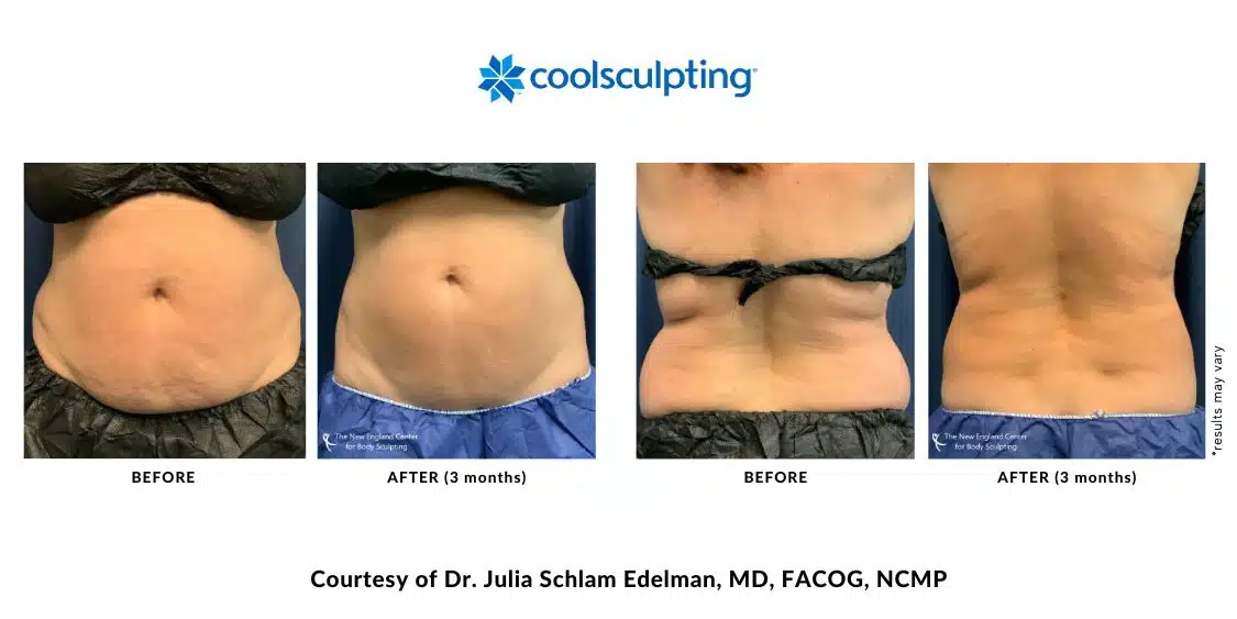 Actual CoolSculpting Elite before and after treatment images by Dr. Julia Edelman in Middleboro, MA