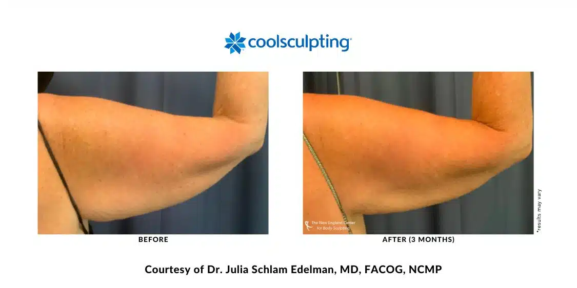 Actual CoolSculpting Elite arm area before and after treatment by Dr. Julia Edelman in Middleboro, MA