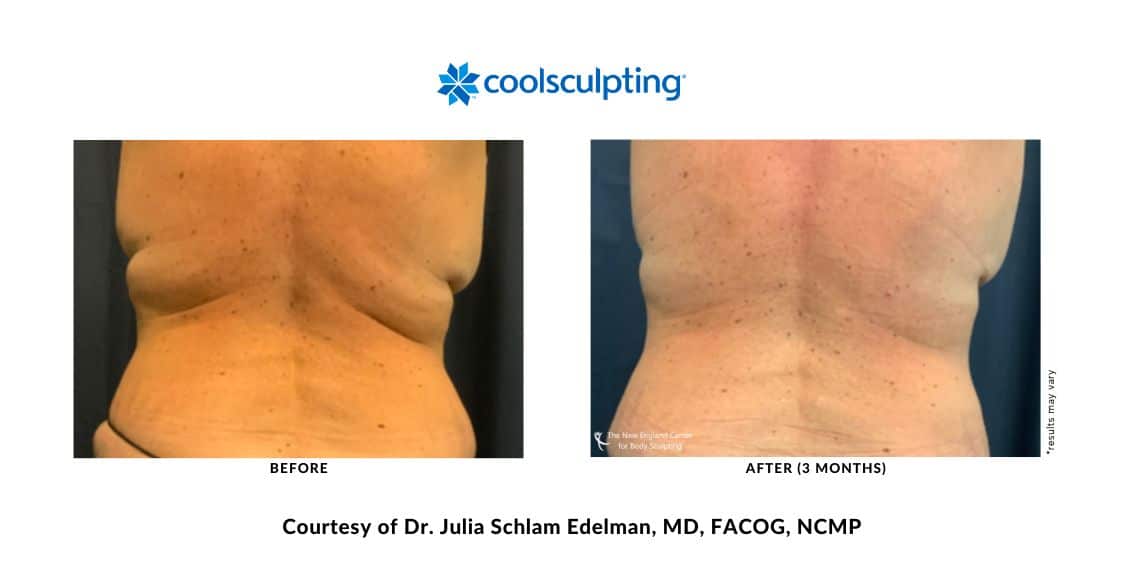 Actual CoolSculpting Elite back bra area before and after treatment by Dr. Julia Edelman in Middleboro, MA