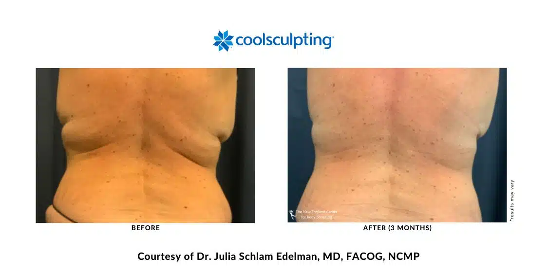 Actual CoolSculpting Elite back bra area before and after treatment by Dr. Julia Edelman in Middleboro, MA