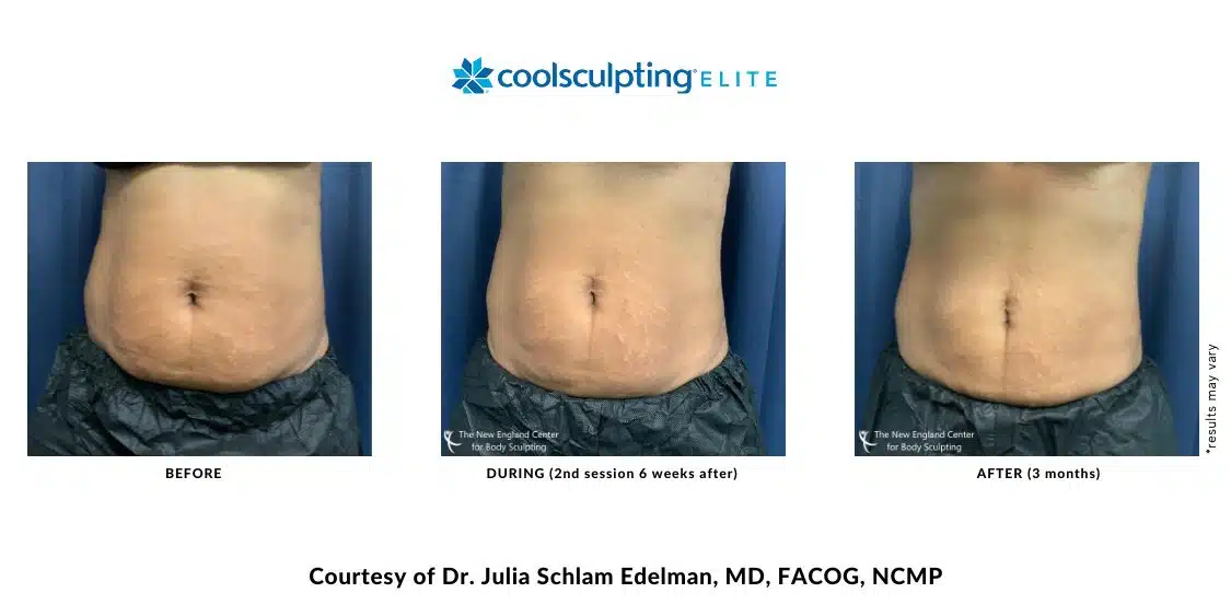 Actual CoolSculpting Elite abdomen area before and after treatment by Dr. Edelman in Middleboro, MA