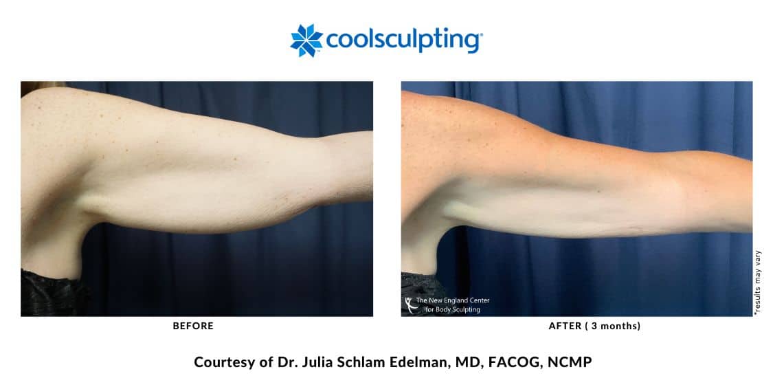 coolsculpting-elite-before-and-after-dr.-edelman-mobile-6 Actual CoolSculpting Elite arm area before and after treatment by Dr. Edelman in Middleboro, MA