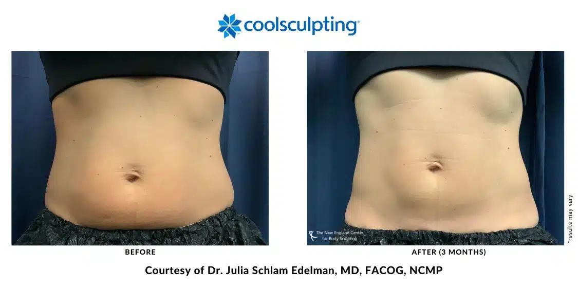 The abdomen area was treated with CoolSculpting Elite by Dr. Edelman.