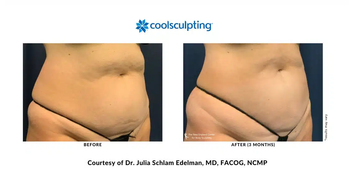 Actual CoolSculpting Elite before and after treatment of the abdomen area by Dr. Julia Edelman in Middleboro, MA