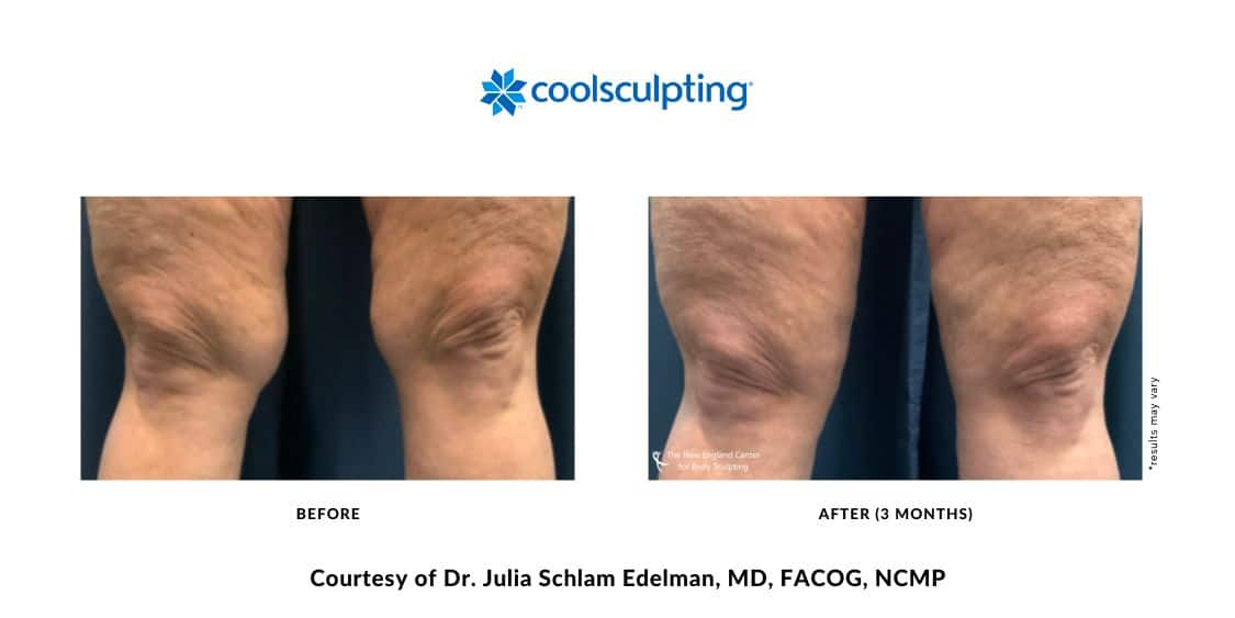 coolsculpting-elite-before-and-after-dr.-edelman-mobile-9 Actual CoolSculpting Elite before and after treatment above the knee area by Dr. Julia Edelman in Middleboro, MA