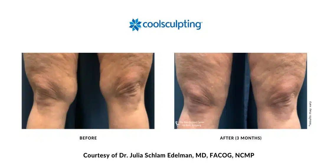 Actual CoolSculpting Elite before and after treatment above the knee area by Dr. Julia Edelman in Middleboro, MA