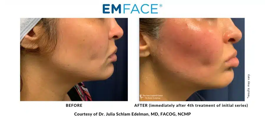 Dr. Julia Edelman's EMFace actual before and after results image in Middleboro, MA
