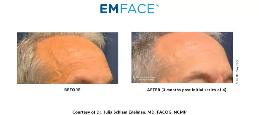 EMFace before and after Forehead treatment with Dr. Julia Edelman in Middleboro, MA