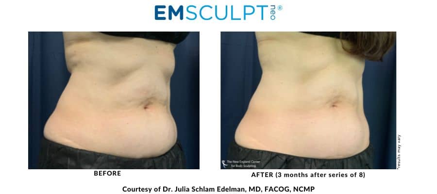 Emsculpt NEO real before and after results by Dr. Julia Edelman