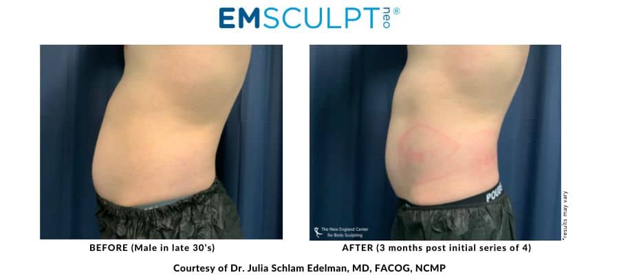 Before and after pictures of Dr. Julia Edelman's Emsculpt abdomen in Middleboro, Massachusetts