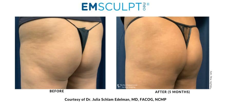 Emsculpt buttocks before and after the procedure with Dr. Julia Edelman in Middleboro, MA