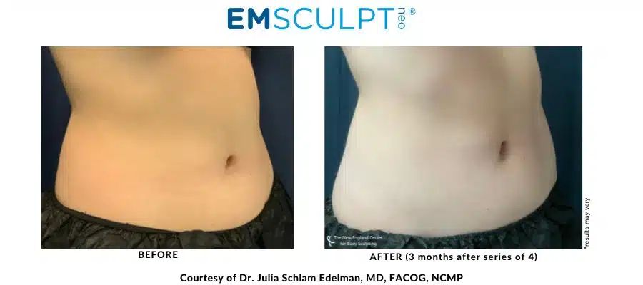 Emsculpt abdomen before and after the procedure with Dr. Julia Edelman in Middleboro, MA