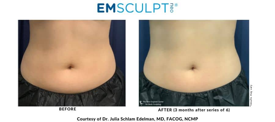Middleboro, Massachusetts doctor Julia Edelman's Emsculpt abdominal area before and after photos