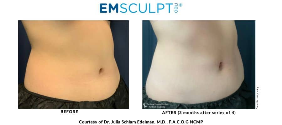 Emsculpt abdomen before and after treatment with Dr. Julia Edelman in Middleboro, MA