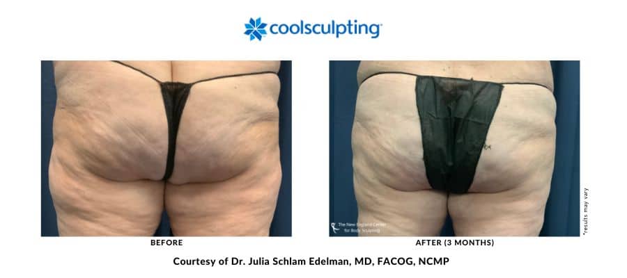 Outer thighs treated with CoolSculpting Elite by Dr. Julia Edelman in Middleboro, Massachusetts, before and after