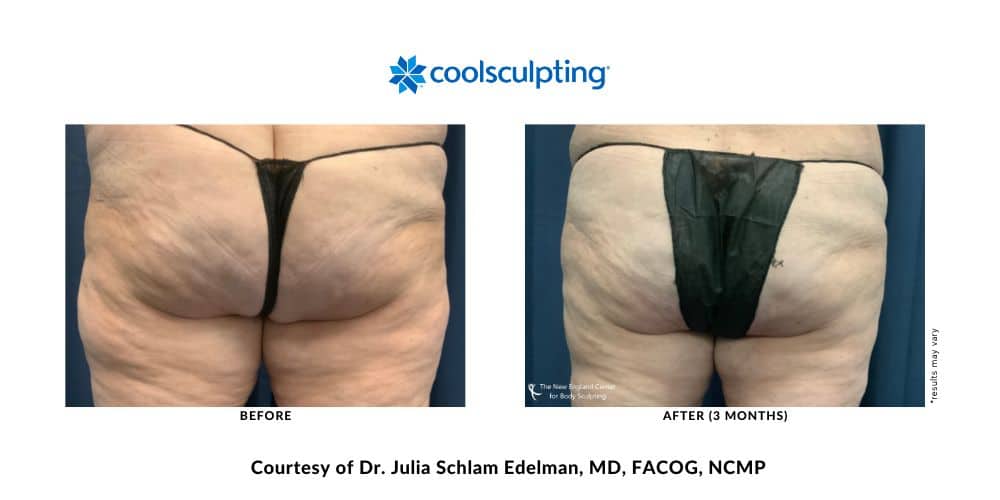 CoolSculpting Elite outer thighs before and after treatment with Dr. Julia Edelman in Middleboro, MA