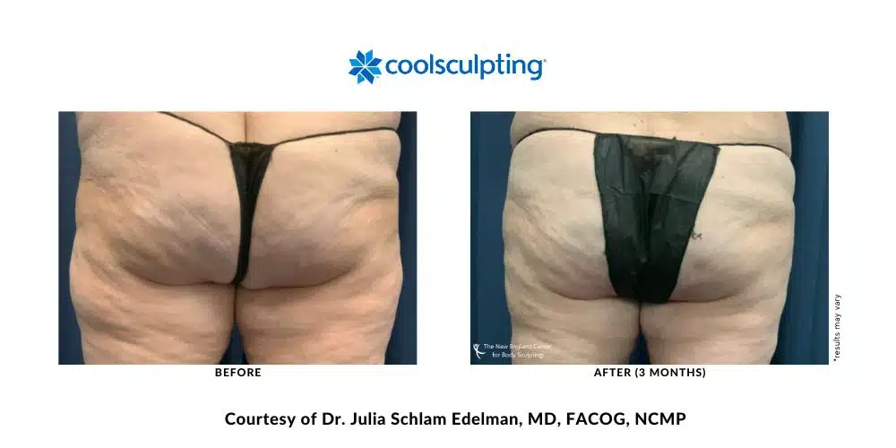 CoolSculpting Elite outer thighs before and after treatment with Dr. Julia Edelman in Middleboro, MA