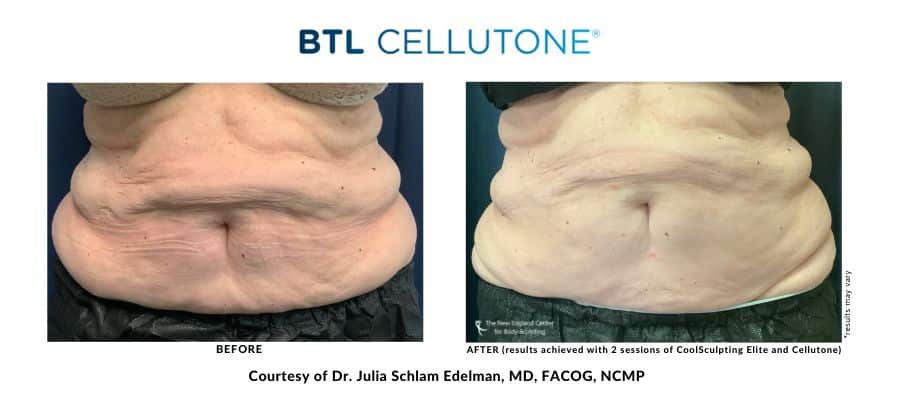 cellutone-cellulite-treatment-before-and-after-image-at-new-england-center-for-body-sculpting cellutone-cellulite-treatment-before-and-after-image-at-new-england-center-for-body-sculpting