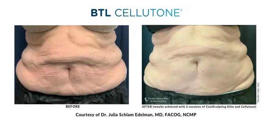 cellutone-cellulite-treatment-before-and-after-image-at-new-england-center-for-body-sculpting