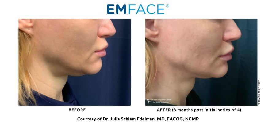 Emface Before and After – The New England Center for Body Sculpting – Middleboro, MA EMFace real before and after result image with Dr. Julia Edelman in Middleboro, MA