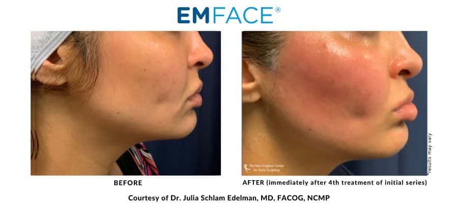 Emface Before and After – The New England Center for Body Sculpting – Middleboro, MA Dr. Julia Edelman's EMFace actual before and after results image in Middleboro, MA