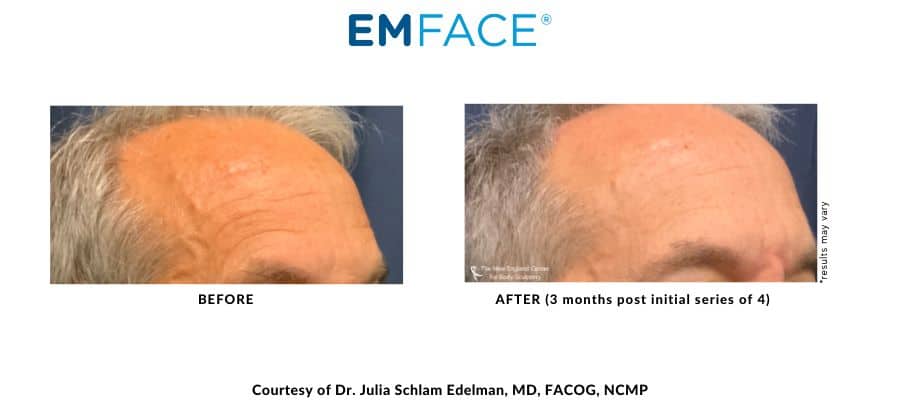 Emface Before and After – The New England Center for Body Sculpting – Middleboro, MA EMFace before and after Forehead treatment with Dr. Julia Edelman in Middleboro, MA