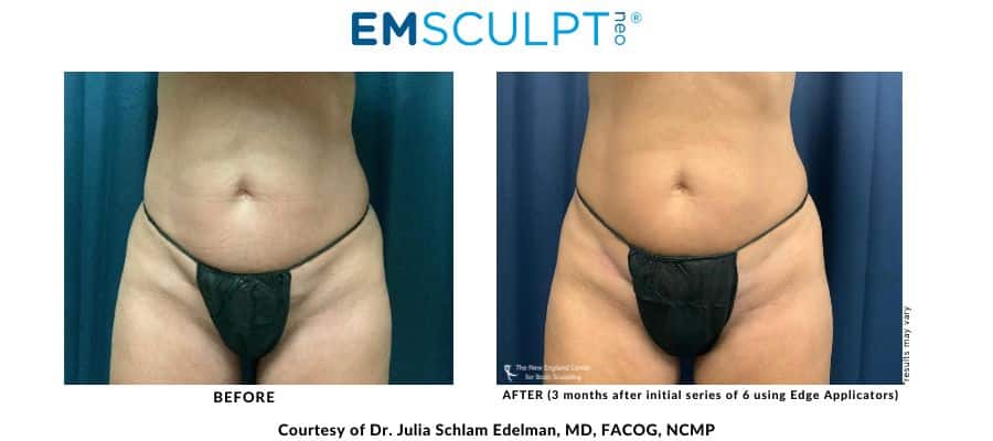 Emsculpt NEO before and after photo treatment Flanks area at Middleboro, MA