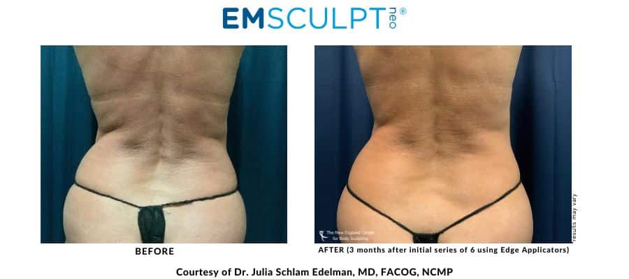 Emsculpt NEO before and after image flanks area at Middleboro, MA