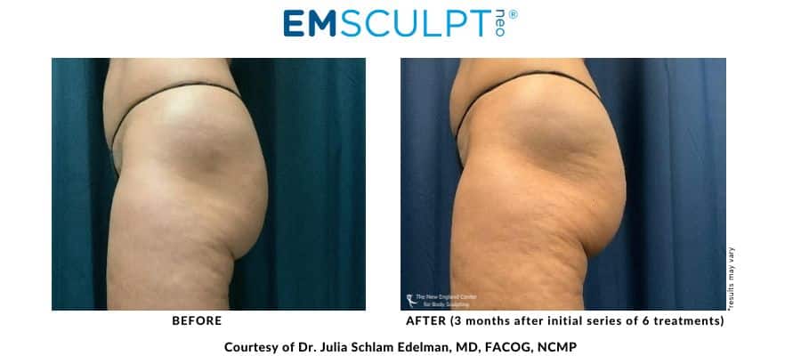 Emsculpt NEO before and after buttocks area at Middleboro, MA