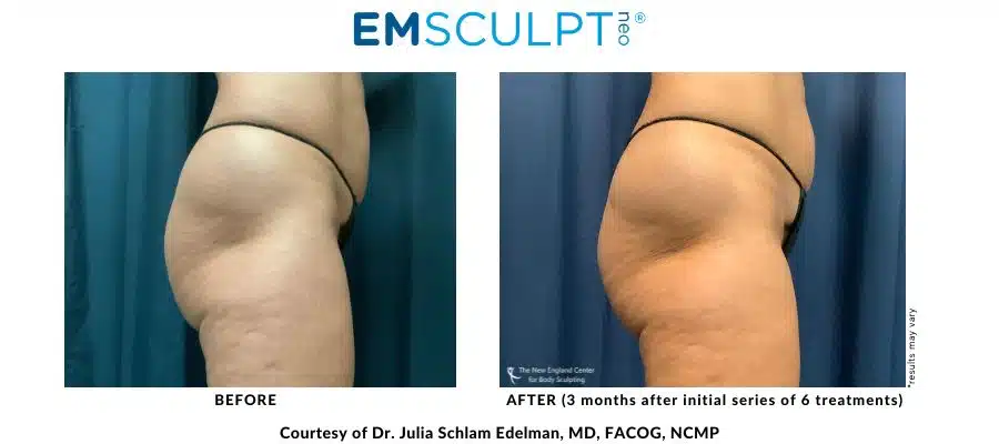 Emsculpt NEO before and after treatment buttocks area at Middleboro, MA