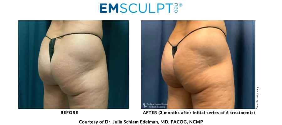 Emsculpt NEO before and after photo treatment buttocks area at Middleboro, MA