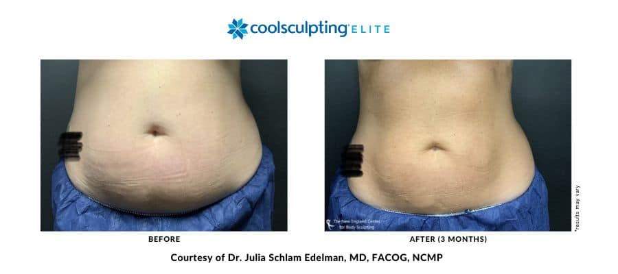 coolsculpting-elite-dr-julia-edelman-middleboro-ma-coolsculpting-before-and-after-desktop-1 coolsculpting-elite-dr-julia-edelman-middleboro-ma-coolsculpting-before-and-after-desktop-1