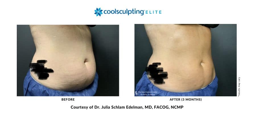 coolsculpting-elite-dr-julia-edelman-middleboro-ma-coolsculpting-before-and-after-desktop-2 coolsculpting-elite-dr-julia-edelman-middleboro-ma-coolsculpting-before-and-after-desktop-2