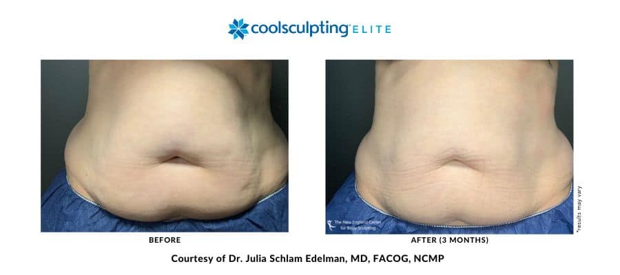 coolsculpting-elite-dr-julia-edelman-middleboro-ma-coolsculpting-before-and-after-desktop-3 coolsculpting-elite-dr-julia-edelman-middleboro-ma-coolsculpting-before-and-after-desktop-3