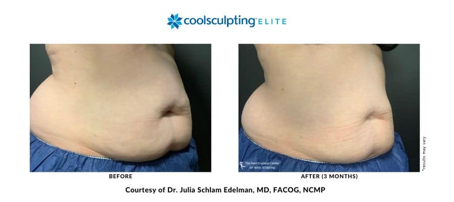 coolsculpting-elite-dr-julia-edelman-middleboro-ma-coolsculpting-before-and-after-desktop-4 coolsculpting-elite-dr-julia-edelman-middleboro-ma-coolsculpting-before-and-after-desktop-4