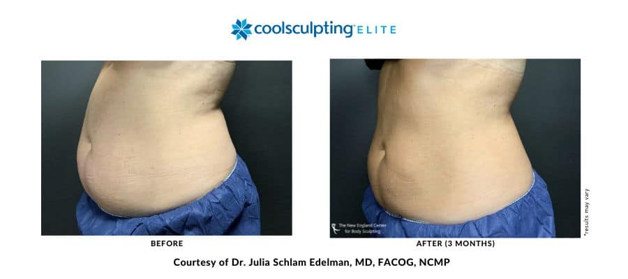 coolsculpting-elite-dr-julia-edelman-middleboro-ma-coolsculpting-before-and-after-desktop-5 coolsculpting-elite-dr-julia-edelman-middleboro-ma-coolsculpting-before-and-after-desktop-5