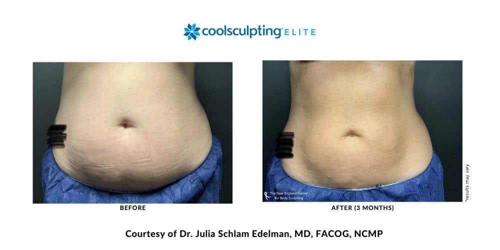 coolsculpting-elite-dr-julia-edelman-middleboro-ma-coolsculpting-before-and-after-mobile-1 coolsculpting-elite-dr-julia-edelman-middleboro-ma-coolsculpting-before-and-after-mobile-1
