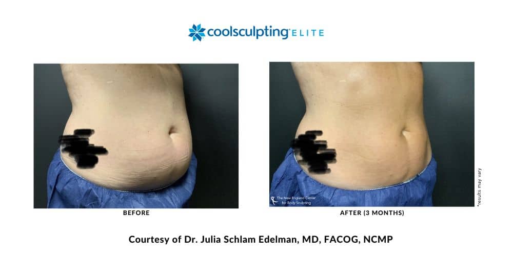 coolsculpting-elite-dr-julia-edelman-middleboro-ma-coolsculpting-before-and-after-mobile-2 coolsculpting-elite-dr-julia-edelman-middleboro-ma-coolsculpting-before-and-after-mobile-2