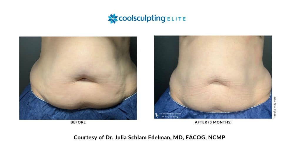 coolsculpting-elite-dr-julia-edelman-middleboro-ma-coolsculpting-before-and-after-mobile-3 coolsculpting-elite-dr-julia-edelman-middleboro-ma-coolsculpting-before-and-after-mobile-3
