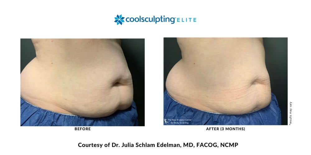coolsculpting-elite-dr-julia-edelman-middleboro-ma-coolsculpting-before-and-after-mobile-4 coolsculpting-elite-dr-julia-edelman-middleboro-ma-coolsculpting-before-and-after-mobile-4