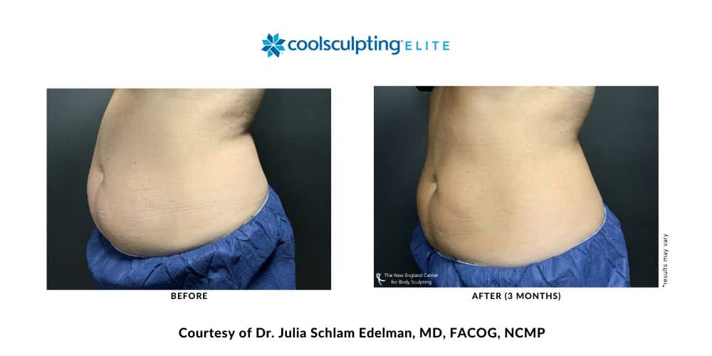 coolsculpting-elite-dr-julia-edelman-middleboro-ma-coolsculpting-before-and-after-mobile-5 coolsculpting-elite-dr-julia-edelman-middleboro-ma-coolsculpting-before-and-after-mobile-5