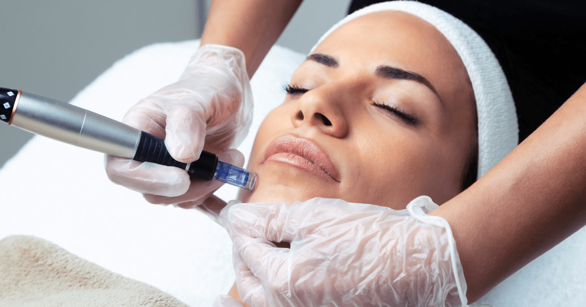 getting-microneedling-2