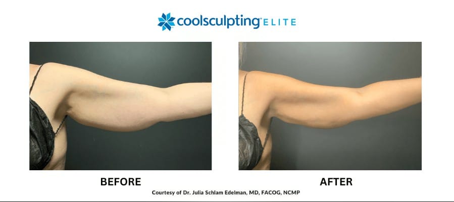 coolsculpting-elite-ba-2-1