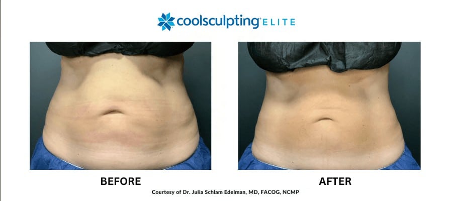 coolsculpting-elite-ba-3-1